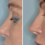 Revision Rhinoplasty Before and After Photos in Miami, FL, Patient 970