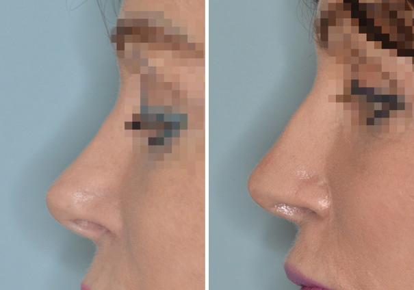 Revision Rhinoplasty Before and After Photos in Miami, FL, Patient 970