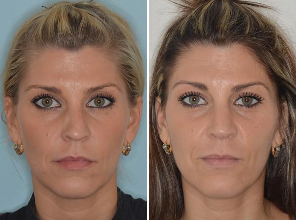 Revision Rhinoplasty Before and After Photos in Miami, FL, Patient 987