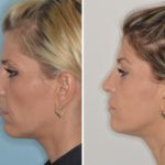 Revision Rhinoplasty Before and After Photos in Miami, FL, Patient 987