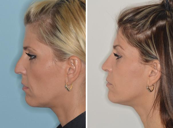 Revision Rhinoplasty Before and After Photos in Miami, FL, Patient 987