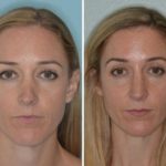 Revision Rhinoplasty Before and After Photos in Miami, FL, Patient 994