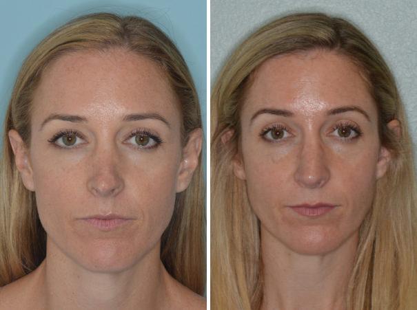 Revision Rhinoplasty Before and After Photos in Miami, FL, Patient 994