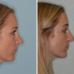 Revision Rhinoplasty Before and After Photos in Miami, FL, Patient 994