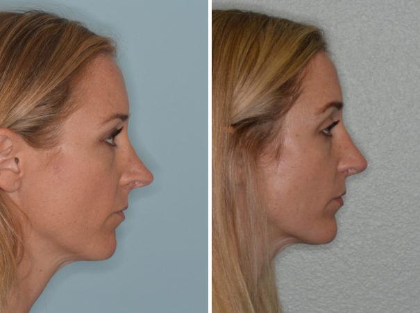 Revision Rhinoplasty Before and After Photos in Miami, FL, Patient 994