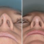 Revision Rhinoplasty Before and After Photos in Miami, FL, Patient 994