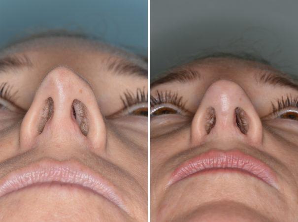 Revision Rhinoplasty Before and After Photos in Miami, FL, Patient 994