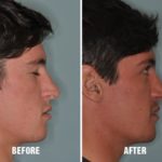Rhinoplasty Before and After Photos in Miami, FL, Patient 174