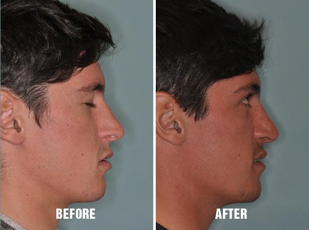 Rhinoplasty Before and After Photos in Miami, FL, Patient 174