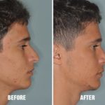 Rhinoplasty Before and After Photos in Miami, FL, Patient 204