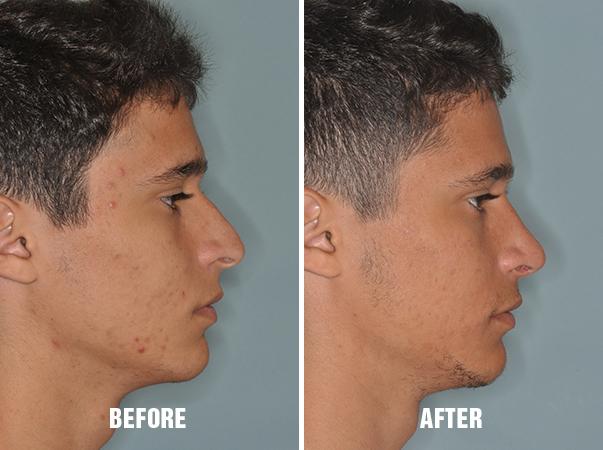 Rhinoplasty Before and After Photos in Miami, FL, Patient 204