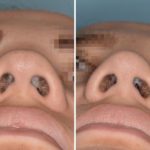 Rhinoplasty Before and After Photos in Miami, FL, Patient 505