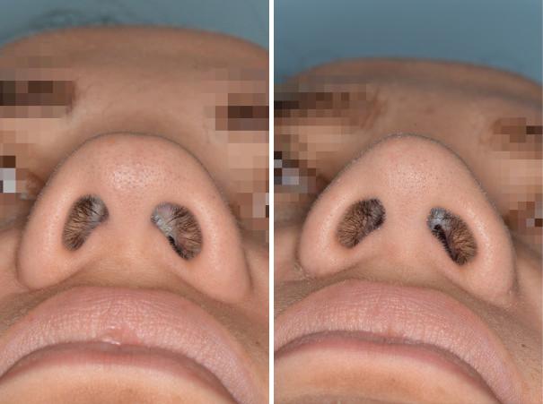 Rhinoplasty Before and After Photos in Miami, FL, Patient 505