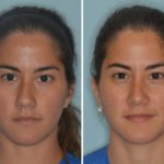 Rhinoplasty Before and After Photos in Miami, FL, Patient 515