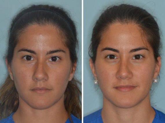 Rhinoplasty Before and After Photos in Miami, FL, Patient 515