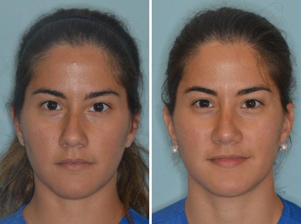 Rhinoplasty Before and After Photos in Miami, FL, Patient 515