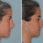 Rhinoplasty Before and After Photos in Miami, FL, Patient 515