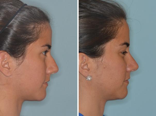 Rhinoplasty Before and After Photos in Miami, FL, Patient 515