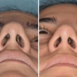 Rhinoplasty Before and After Photos in Miami, FL, Patient 515