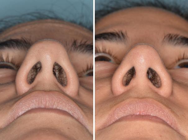 Rhinoplasty Before and After Photos in Miami, FL, Patient 515