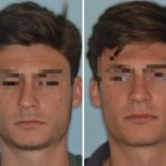 Rhinoplasty Before and After Photos in Miami, FL, Patient 525