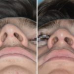 Rhinoplasty Before and After Photos in Miami, FL, Patient 525