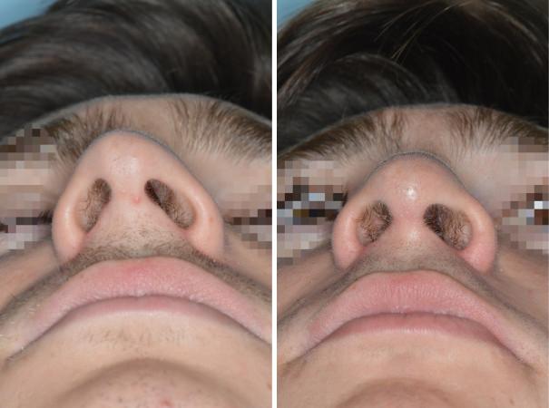 Rhinoplasty Before and After Photos in Miami, FL, Patient 525