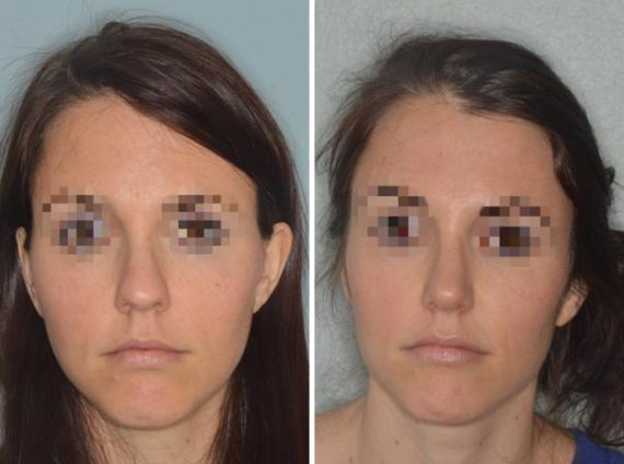 Rhinoplasty Before and After Photos in Miami, FL, Patient 539