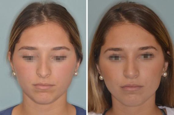 Rhinoplasty Before and After Photos in Miami, FL, Patient 543