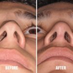 Rhinoplasty Before and After Photos in Miami, FL, Patient 204