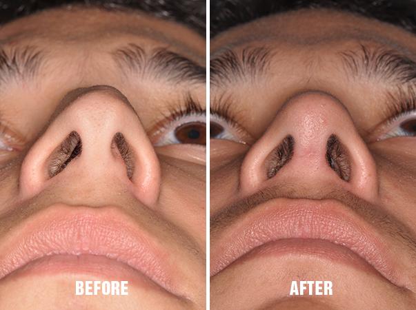 Rhinoplasty Before and After Photos in Miami, FL, Patient 204