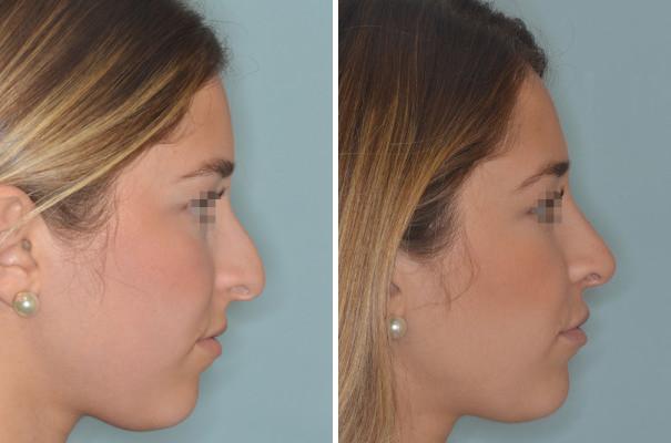 Rhinoplasty Before and After Photos in Miami, FL, Patient 543