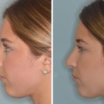 Rhinoplasty Before and After Photos in Miami, FL, Patient 543