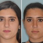 Rhinoplasty Before and After Photos in Miami, FL, Patient 553