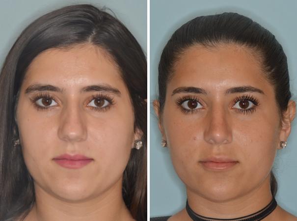 Rhinoplasty Before and After Photos in Miami, FL, Patient 553
