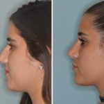 Rhinoplasty Before and After Photos in Miami, FL, Patient 553