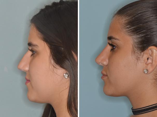 Rhinoplasty Before and After Photos in Miami, FL, Patient 553