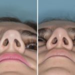Rhinoplasty Before and After Photos in Miami, FL, Patient 553