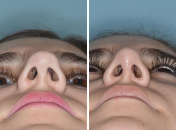Rhinoplasty Before and After Photos in Miami, FL, Patient 553