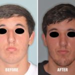 Rhinoplasty Before and After Photos in Miami, FL, Patient 563