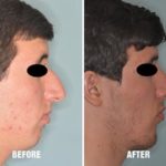 Rhinoplasty Before and After Photos in Miami, FL, Patient 563