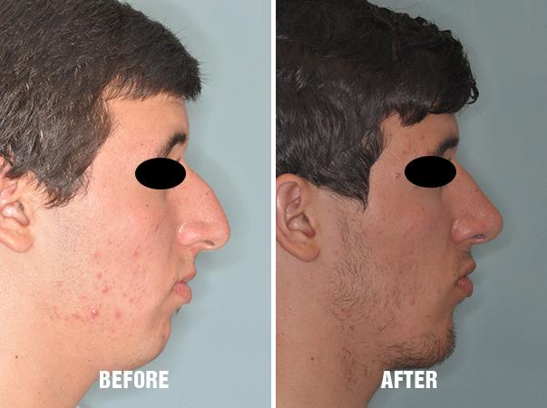 Rhinoplasty Before and After Photos in Miami, FL, Patient 563