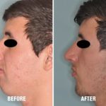 Rhinoplasty Before and After Photos in Miami, FL, Patient 563