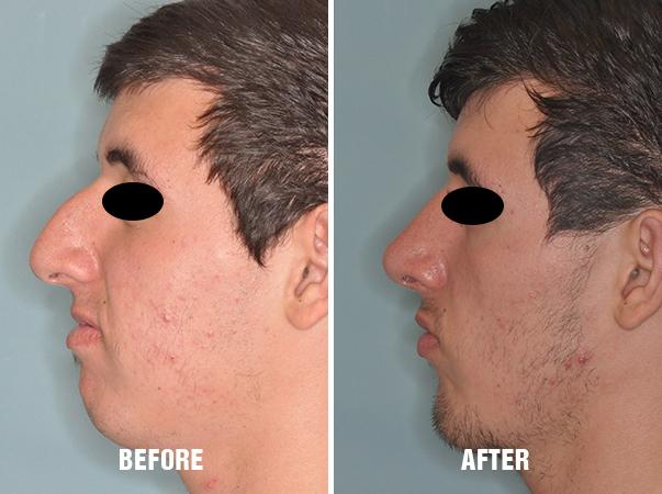 Rhinoplasty Before and After Photos in Miami, FL, Patient 563