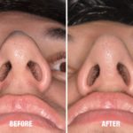 Rhinoplasty Before and After Photos in Miami, FL, Patient 563