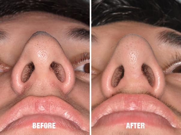 Rhinoplasty Before and After Photos in Miami, FL, Patient 563