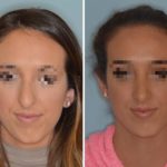 Rhinoplasty Before and After Photos in Miami, FL, Patient 576