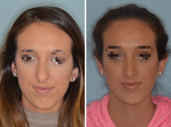 Rhinoplasty Before and After Photos in Miami, FL, Patient 576