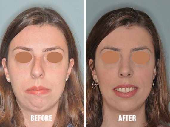 Rhinoplasty Before and After Photos in Miami, FL, Patient 222