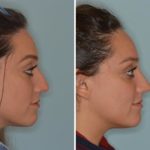 Rhinoplasty Before and After Photos in Miami, FL, Patient 592